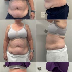 BioLift Med Spa - Cryo fat freezing