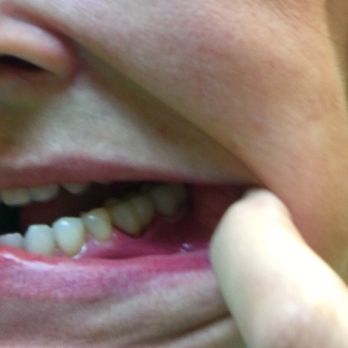 Lake Park Dental - After lasered gum - Cosmetic Dentists Near Me - Lutz, Florida Lake Park Dental - After lasered gum - Cosmetic Dentists Near Me - Lutz, Florida