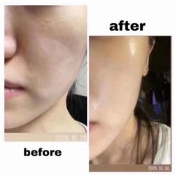 Lady Ann’s Beauty studio - 水光针