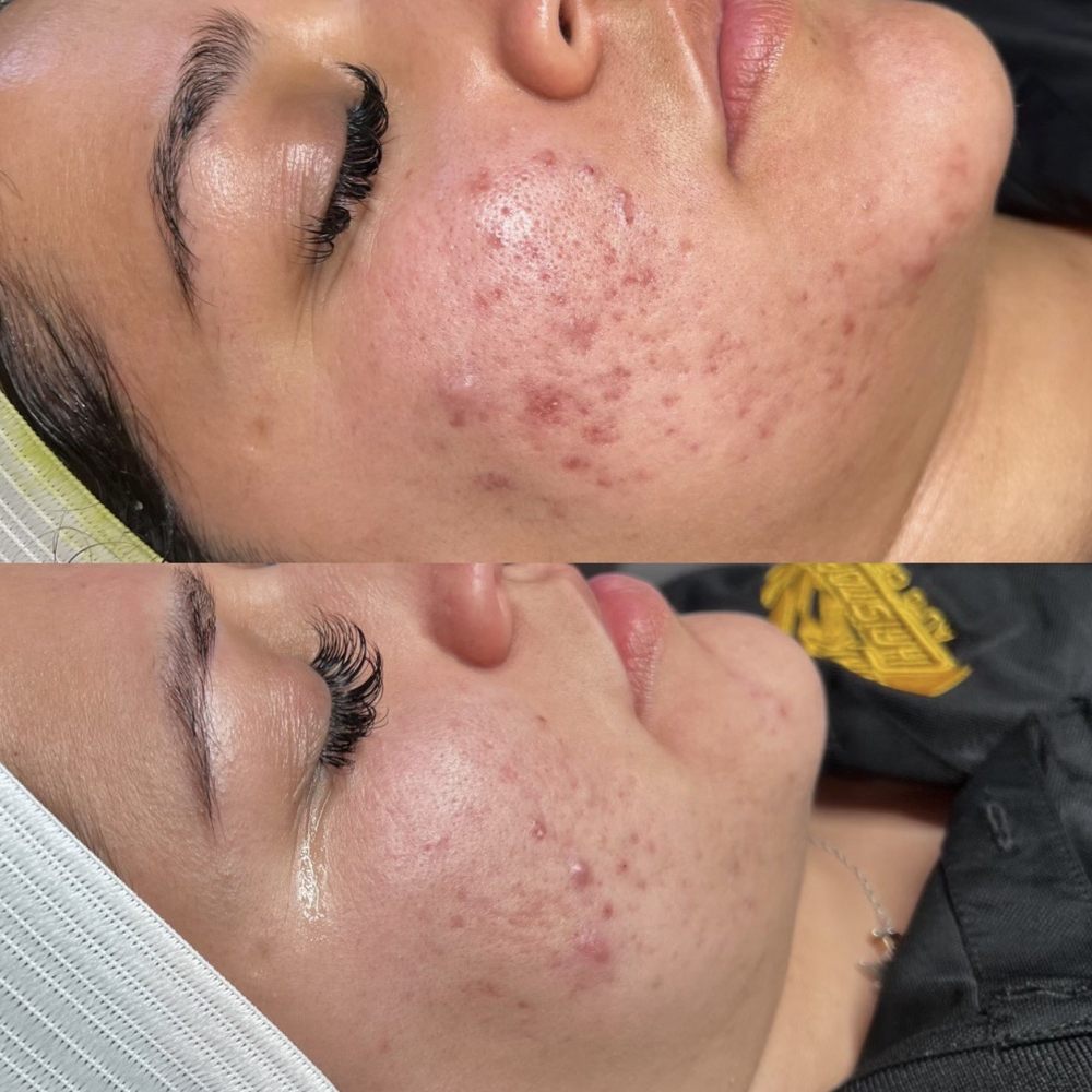 YS Aesthetics - Such a big difference - Skin Care Near Me - Rancho Cucamonga, California YS Aesthetics - Such a big difference - Skin Care Near Me - Rancho Cucamonga, California