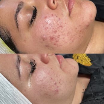 YS Aesthetics - Such a big difference - Skin Care Near Me - Rancho Cucamonga, California YS Aesthetics - Such a big difference - Skin Care Near Me - Rancho Cucamonga, California