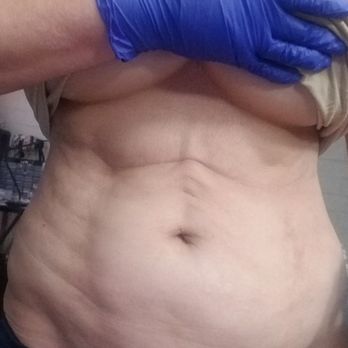 Elite Plastic Surgery - I think Dr. Torabi tried to created a six pack, but that's not what I wanted it. - Cosmetic Surgeons Near Me - Phoenix, Arizona Elite Plastic Surgery - I think Dr. Torabi tried to created a six pack, but that's not what I wanted it. - Cosmetic Surgeons Near Me - Phoenix, Arizona