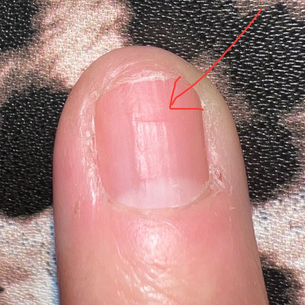 Zen Nail Lounge - The tip of my nail is still paper thin. Looking forward to my nail growing past this dent the salon made with their aggressive drilling. - Nail Salons Near Me - Montebello, California Zen Nail Lounge - The tip of my nail is still paper thin. Looking forward to my nail growing past this dent the salon made with their aggressive drilling. - Nail Salons Near Me - Montebello, California