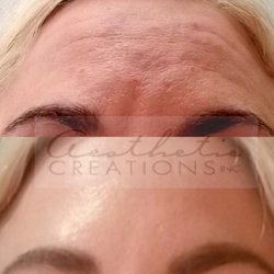 Aesthetic Creations Inc - Above = B4 Botox Treatment   Below ~ One Month Post-Botox Injections by Rose Streeter, RN.  Skin treatments by myself, Complexionist.com