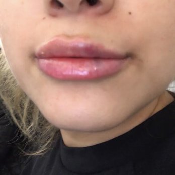 Usha Rajagopal, MD - 1 syringe (after) - Cosmetic Surgeons Near Me - San Francisco, California Usha Rajagopal, MD - 1 syringe (after) - Cosmetic Surgeons Near Me - San Francisco, California