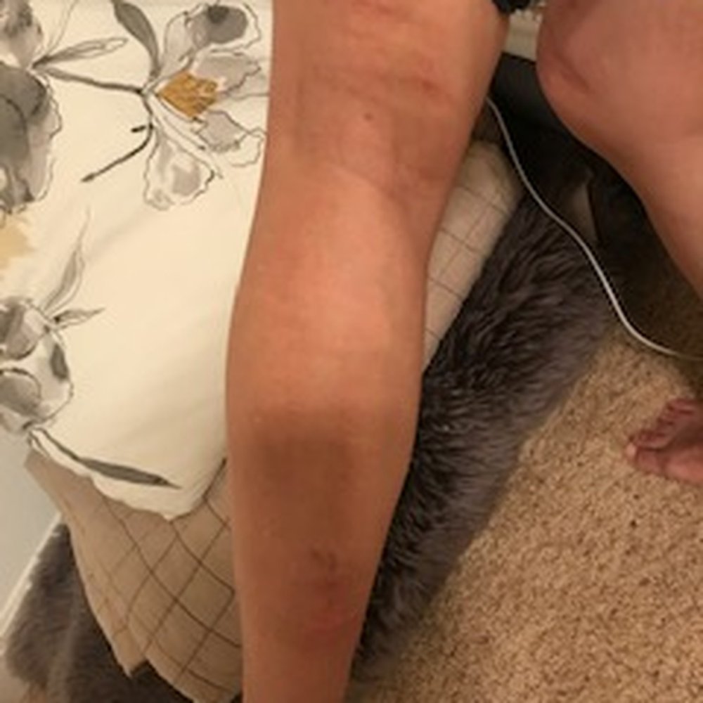 Cryo Wellness - Both the front and back from her legs are severely burned. - Undersea/Hyperbaric Medicine Near Me - Austin, Texas Cryo Wellness - Both the front and back from her legs are severely burned. - Undersea/Hyperbaric Medicine Near Me - Austin, Texas