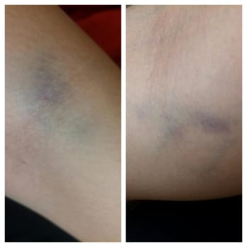 Quest Diagnostics - Bruises left on my left and right arms by Dana and Patricia. - Laboratory Testing Near Me - Newport Beach, California Quest Diagnostics - Bruises left on my left and right arms by Dana and Patricia. - Laboratory Testing Near Me - Newport Beach, California