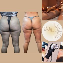 Flawless Aesthetic - Take a look at our cellulite treatment on this patient.