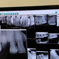 Monarch Dental & Orthodontics - X-Ray of broken #4 upper tooth  to be removed.