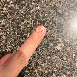 Bacteria growing on nail due to poor application of acrylics