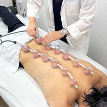 Hope Acupuncture - Benefits of Modern Cupping (Massage style Cupping) 1. Better blood flow 2. Muscle relaxation 3. Lymphatic support 4. Skin stimulation - Acupuncture Near Me - Stanton, California Hope Acupuncture - Benefits of Modern Cupping (Massage style Cupping) 1. Better blood flow 2. Muscle relaxation 3. Lymphatic support 4. Skin stimulation - Acupuncture Near Me - Stanton, California
