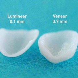 Paragon Dental - Minimal Preparation veneers to transform a smile quickly.