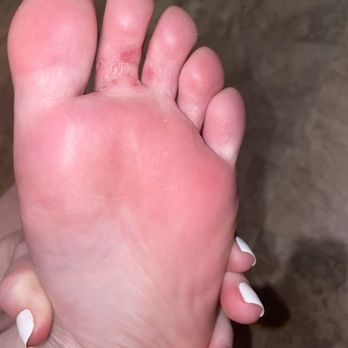 Nail Poetry - Tinea pedis (athlete's foot) - Nail Salons Near Me - Rohnert Park, California Nail Poetry - Tinea pedis (athlete's foot) - Nail Salons Near Me - Rohnert Park, California