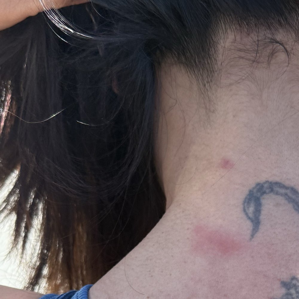 SpringHill Suites by Marriott Newark Fremont - Bed bugs bite on back of my neck. - Hotels Near Me - Newark, California