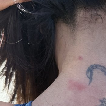 SpringHill Suites by Marriott Newark Fremont - Bed bugs bite on back of my neck. - Hotels Near Me - Newark, California SpringHill Suites by Marriott Newark Fremont - Bed bugs bite on back of my neck. - Hotels Near Me - Newark, California