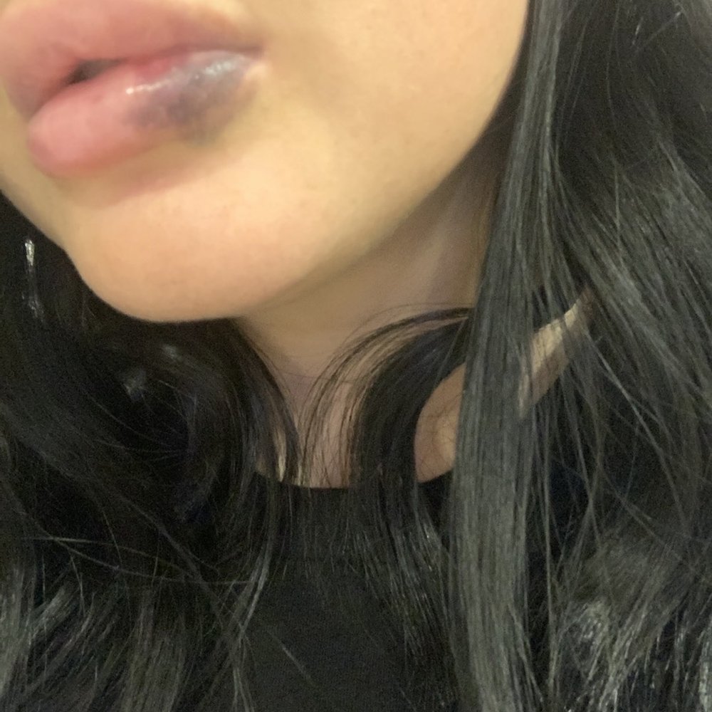 Steven K Struck, MD - Busted blood vessel - Cosmetic Surgeons Near Me - Atherton, California Steven K Struck, MD - Busted blood vessel - Cosmetic Surgeons Near Me - Atherton, California