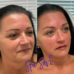 Spa Savi - Lip And Cheek Filler