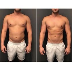 MedSpaPGH - Emsculpt NEO body contouring results at MedSpaPGH.com