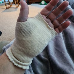 The Hale Hand Center - Left hand done in February... Therapy began the following day!