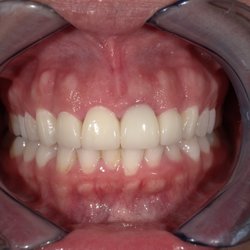 Agave Dental Care - Cosmetic Makeover with Veneers