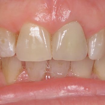 Patrick Yoshikane, DDS - After - Oral Surgeons Near Me - Orange, California Patrick Yoshikane, DDS - After - Oral Surgeons Near Me - Orange, California