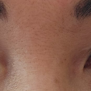 Adam J Cohen, MD - Horrific eyelids and damaged vision after 2nd surgery. - Cosmetic Surgeons Near Me - Glenview, Illinois Adam J Cohen, MD - Horrific eyelids and damaged vision after 2nd surgery. - Cosmetic Surgeons Near Me - Glenview, Illinois