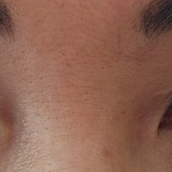Adam J Cohen, MD - Horrific eyelids and damaged vision after 2nd surgery.