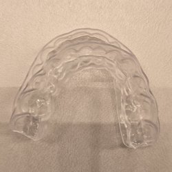 Smile Marysville - Retainers show overbite and misalignment