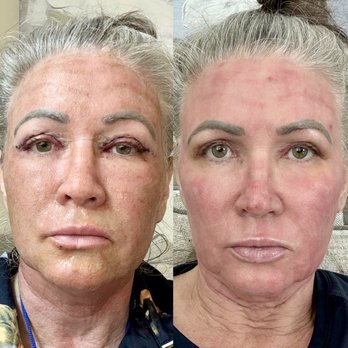 David Kaufman, MD - The Natural Result - 1 day and 1 week - Plastic Surgeons Near Me - Folsom, California David Kaufman, MD - The Natural Result - 1 day and 1 week - Plastic Surgeons Near Me - Folsom, California