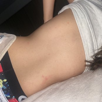 Park Royal - Bed bug bites - Resorts Near Me - Puerto Vallarta, JAL