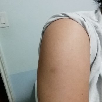 Serene Massage - Bruises still here 3 days later and this is just my arm. - Massage Near Me - Westminster, California