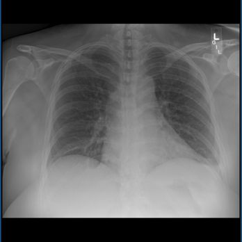 Advent Health - My lungs. Once again. No one ever explained this to me. - Hospitals Near Me - Palm Coast, Florida Advent Health - My lungs. Once again. No one ever explained this to me. - Hospitals Near Me - Palm Coast, Florida