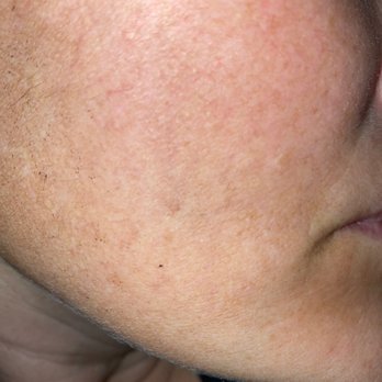 Touch Up Laser - Laser Hair Removal Near Me - Las Vegas, Nevada Touch Up Laser - Laser Hair Removal Near Me - Las Vegas, Nevada