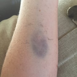 Morton Plant Hospital - Great timing in the ER in and out in less than two hours but horrible IV bruised today like no other..