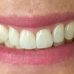 Casey M Herrera, DDS - AFTER