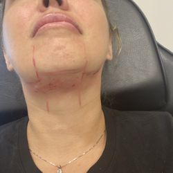 Breeze Med Spa - After the procedure!