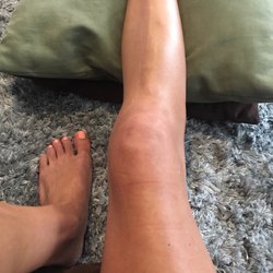 Carlsbad Surgery Center - 4 weeks post op. Meniscus repair and cadaver ACL. These scars are so small for such a detailed surgery.