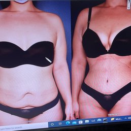 3 Months Post Op. 3 Months Post Op.