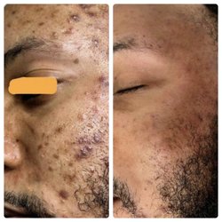Vtina Microblading by Valentina - SQT BioMicroneedling @ Vtinabeauty 615 300-1967