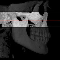 Mark Mollner, DDS - 3-D Cone Beam CT