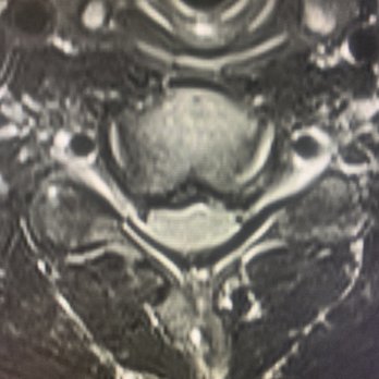 Tenckhoff Chiropractic - MRI of cervical disc injury - Chiropractors Near Me - Brea, California Tenckhoff Chiropractic - MRI of cervical disc injury - Chiropractors Near Me - Brea, California