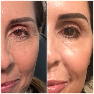 New Client Special - Experience ultimate rejuvenation and indulge in our extraordinary New Client Special! 💆‍♀️✨ Uncover the unbeatable offer of $650 fillers using code NCS650 and $10/unit Tox Injections with code NCS10. Elevate your experience by booking a combination appointment and enjoy a remarkable additional $50 off! 😍✨ Act swiftly, for this remarkable deal is simply irresistible! Secure your spot now at the enchanting Rejuvenateoakley.com! 💕