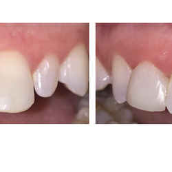 Safer Family & Cosmetic Dentistry - Before and After Photo - Composite Bonding done by Dr. Jason Safer