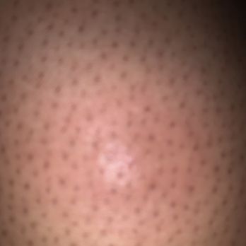 Crystal Gateway Marriott - Bug bites - Hotels Near Me - Arlington, Virginia