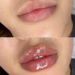 Before & after needle-less lip fillers