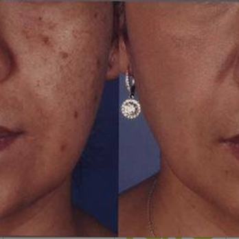 Laser Aesthetic - Laser Hair Removal Near Me - Methuen, Massachusetts