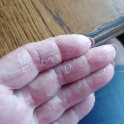 MacDougall Jamie L MD - Peeling Fingers
