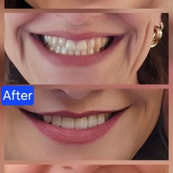 Morgan Hill Dental Care - Dr. Shahzad Afghani is an artist. Look at the before and after! My teeth look very natural and better than I ever expected.
