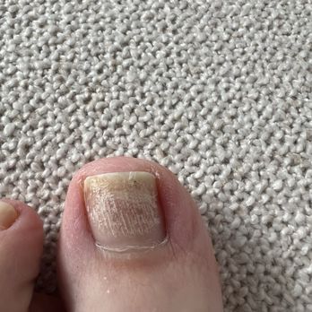 Quality Spa Nails - Nail - A fingernail with visible damage and peeling is shown against a textured, light-colored carpet background. - Nail Technicians Near Me - Long Grove, Illinois