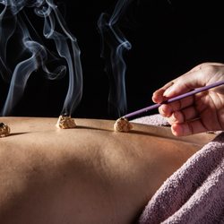 Lien On Me Acupuncture - Moxibustion feels ohhhh so nice!